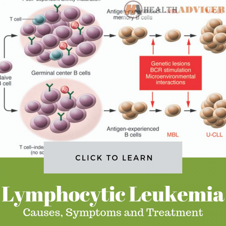 Chronic Lymphocytic Leukemia Causes Picture Symptoms Treatment