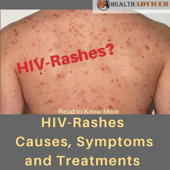 HIV Rashes Causes Picture Symptoms And Treatment