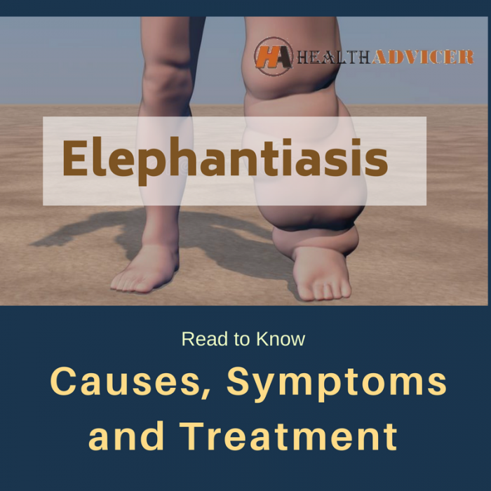 Elephantiasis Causes Symptoms Treatment And Prevention 5237