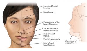 Acromegaly : Causes, Picture, Sign, Symptoms And Treatment