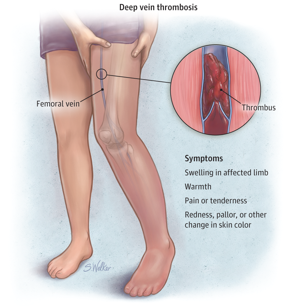 Pain Behind The Knee Causes Picture Symptoms And Treatment