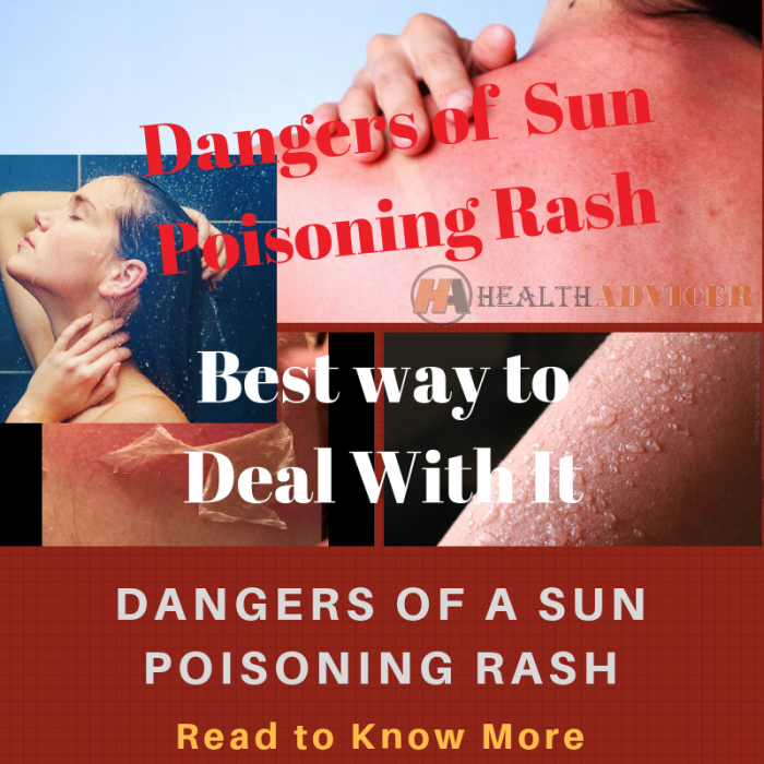 sun-poisoning-symptoms-pictures-causes-and-treatments