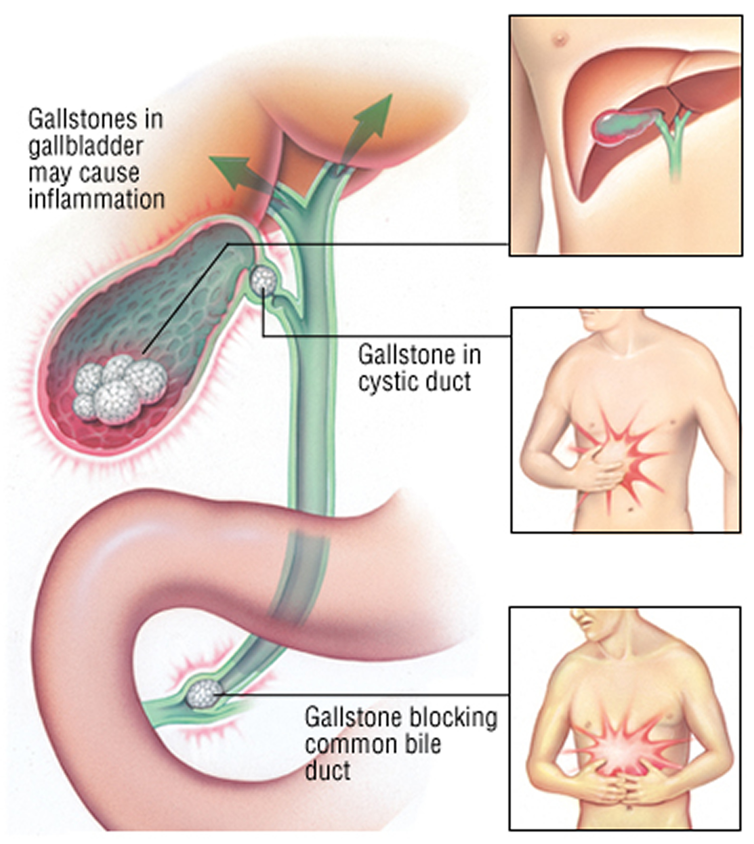 Biliary Colic Causes Picture Symptoms And Treatment