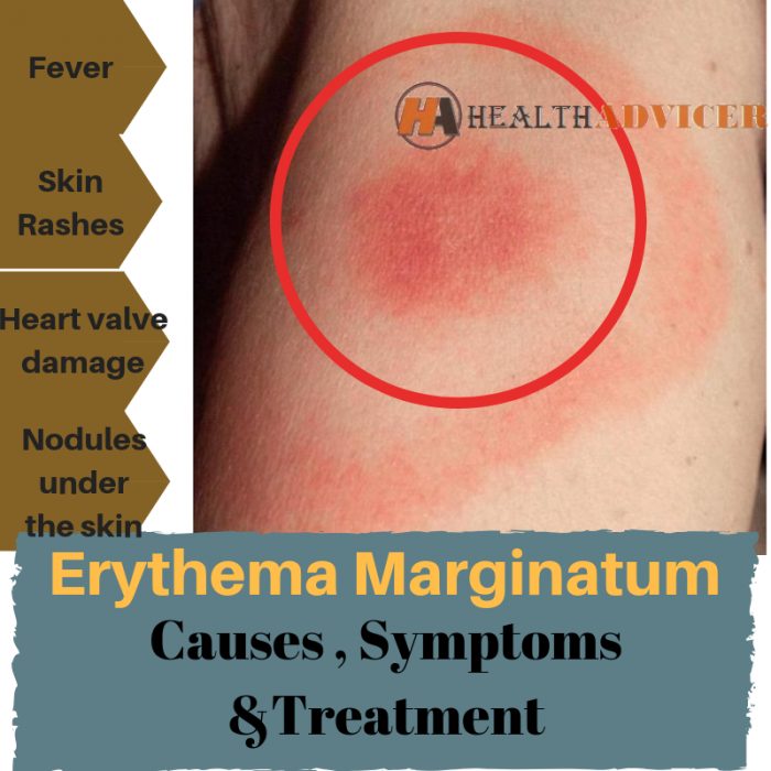 Erythema Marginatum: Causes, Picture, Symptoms And Treatment