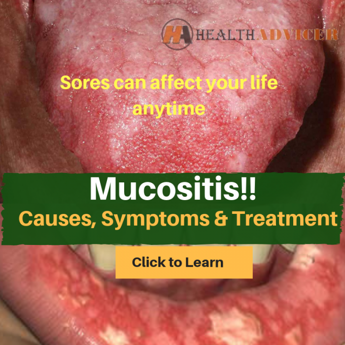 Mucositis : Causes, Picture, Symptoms, Diagnosis and Treatment