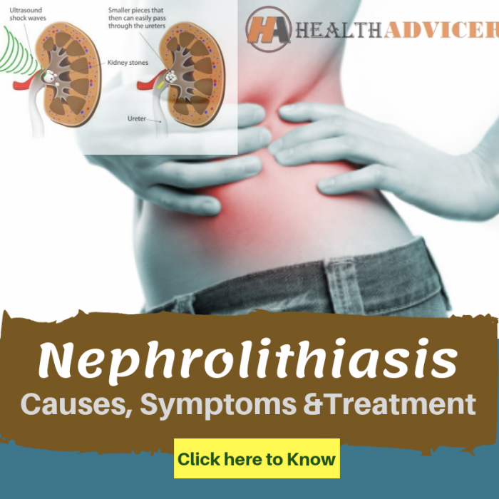 nephrolithiasis-causes-picture-symptoms-and-treatment