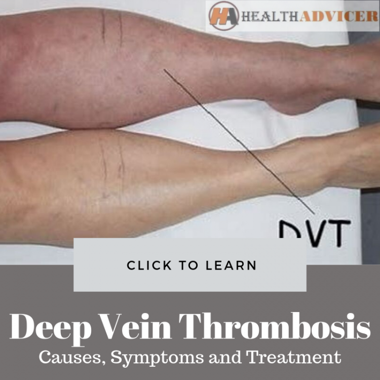 Deep Vein Thrombosis Causes Picture Symptoms And Treatment – NBKomputer