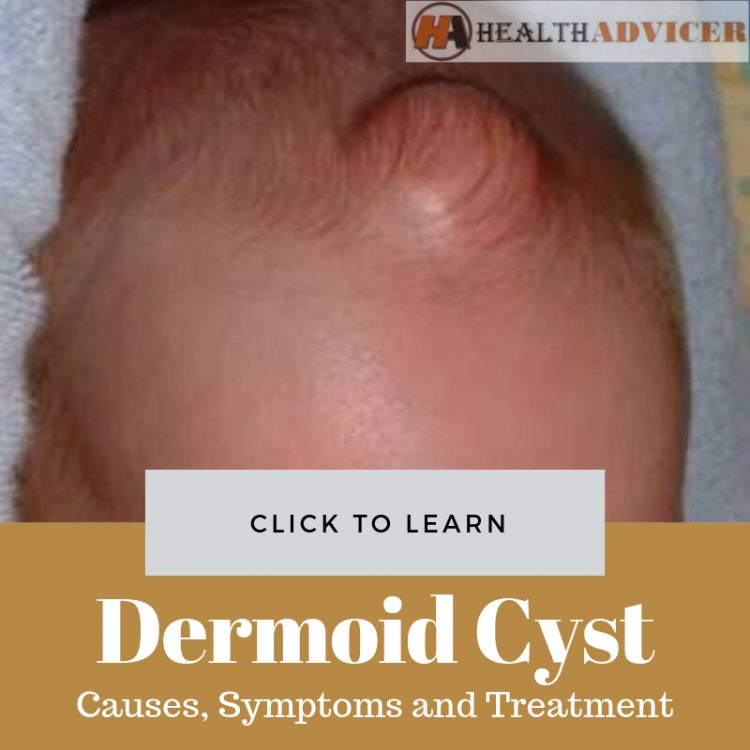Dermoid Cyst E1569006271827 