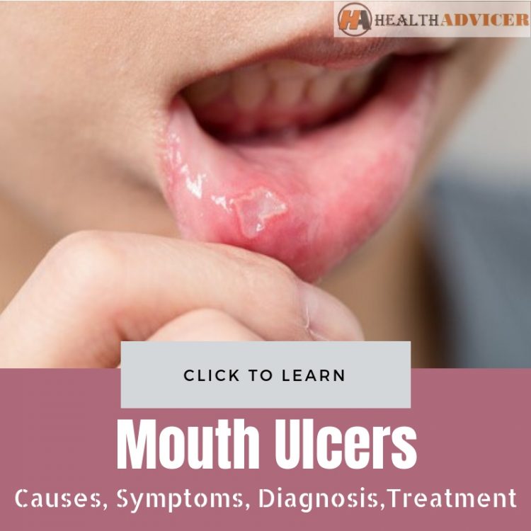 Mouth Ulcers Causes Picture Symptoms Diagnosis And Treatment