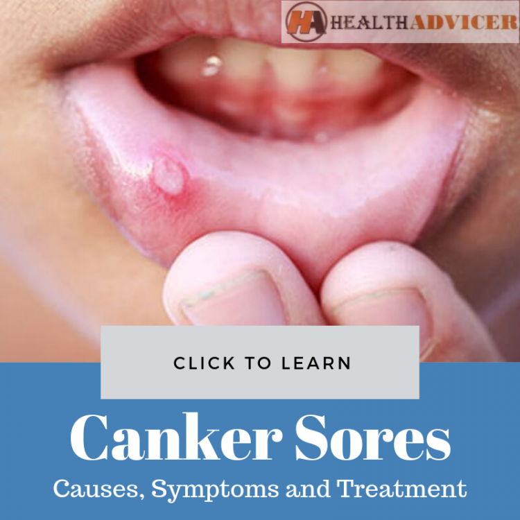 Canker Sores Causes, Picture, Symptoms and Treatment