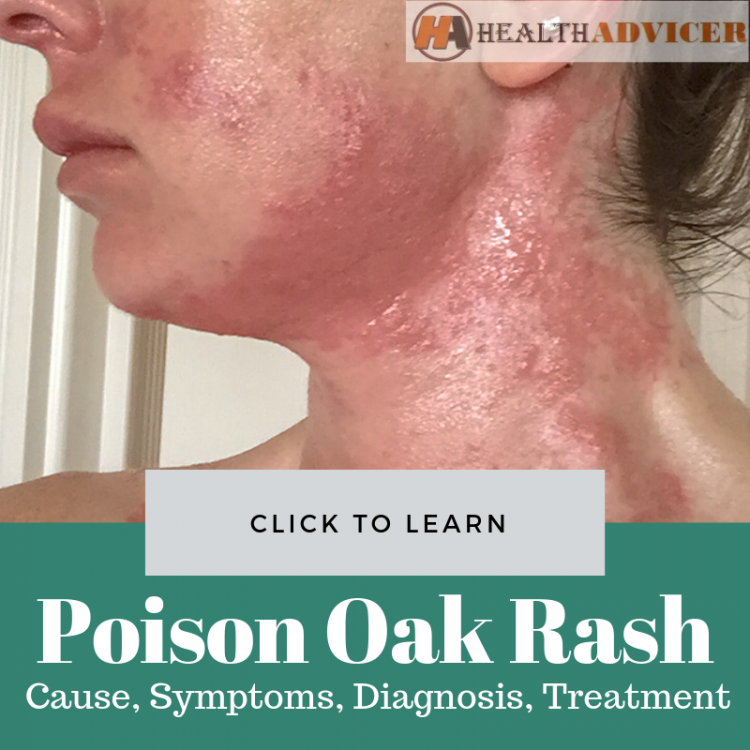 poison-oak-rash-causes-picture-symptoms-and-treatment