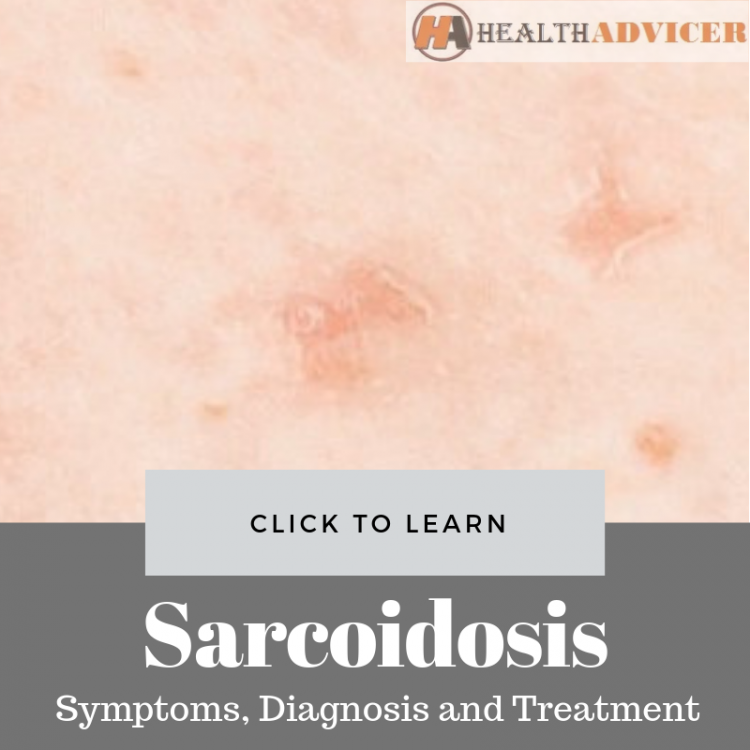 Sarcoidosis: Symptoms, Picture, Diagnosis and Treatment