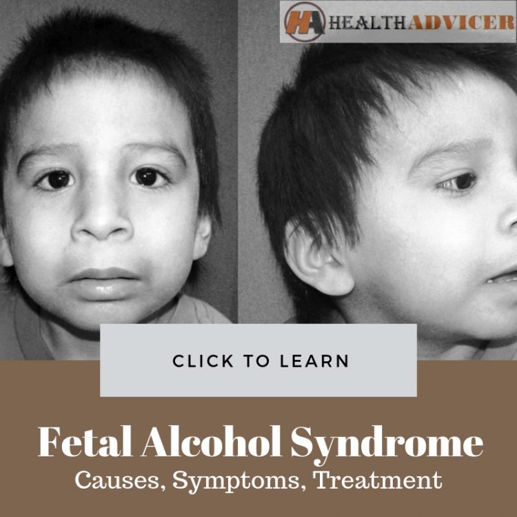 Фото детей с фетальным алкогольным синдромом