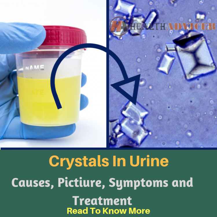 Crystals In Urine Causes, Picture, Symptoms and Treatment