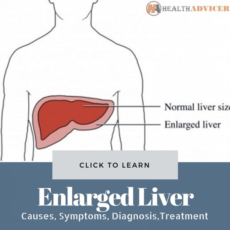 Enlarged Liver: Causes, Picture, Symptoms, And Treatment