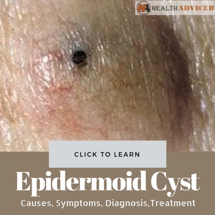 Epidermoid Cyst Causes Picture Symptoms And Treatment 