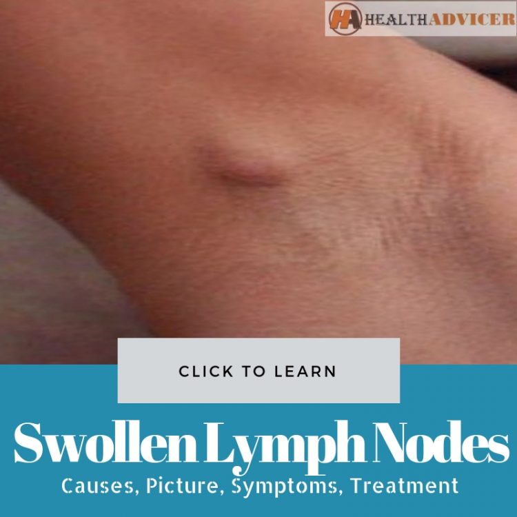 swollen supraclavicular lymph nodes after flu shot