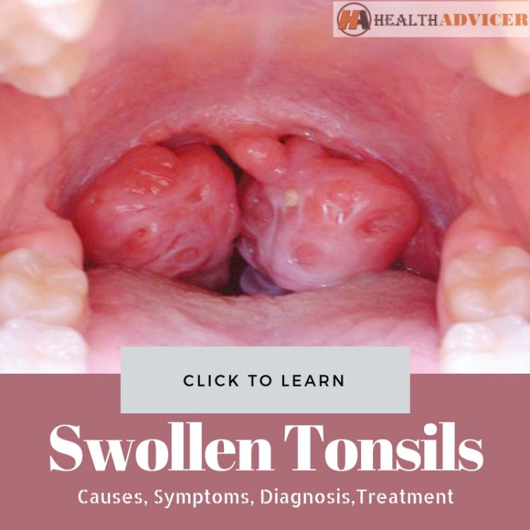 Swollen Tonsils Causes Picture Symptoms And Treatment