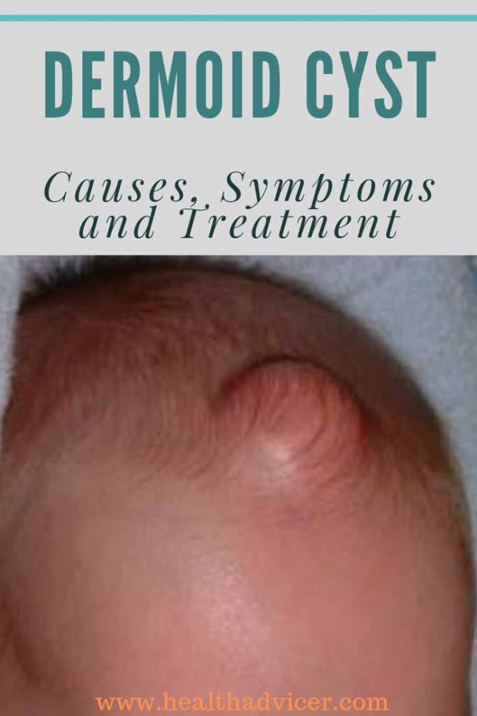 dermoid-cyst-causes-picture-symptoms-and-treatment