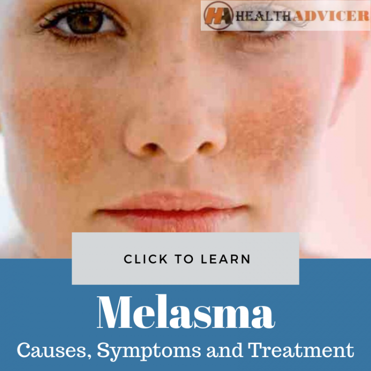 Melasma Causes Picture Symptoms And Treatment