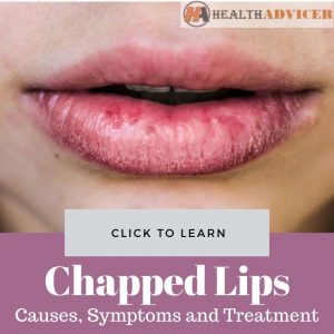 Chapped Lips: Causes, Picture, Symptoms And Treatment