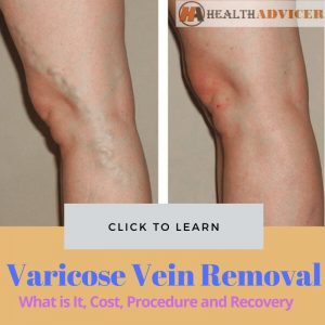 Varicose Vein Removal: What Is It, Factors, Cost, Procedure And Recovery