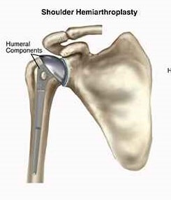 Shoulder Replacement: Factors To Consider, Cost, Procedure And Recovery
