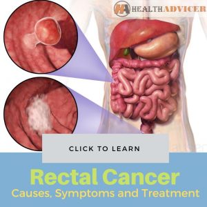 Rectal Cancer - Causes, Picture, Symptoms And Treatment