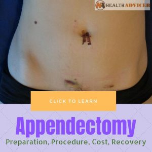 Appendectomy: Risks, Preparation, Procedure, Cost, Recovery