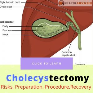 Cholecystectomy: Risks, Preparation, Procedure, Cost, Recovery