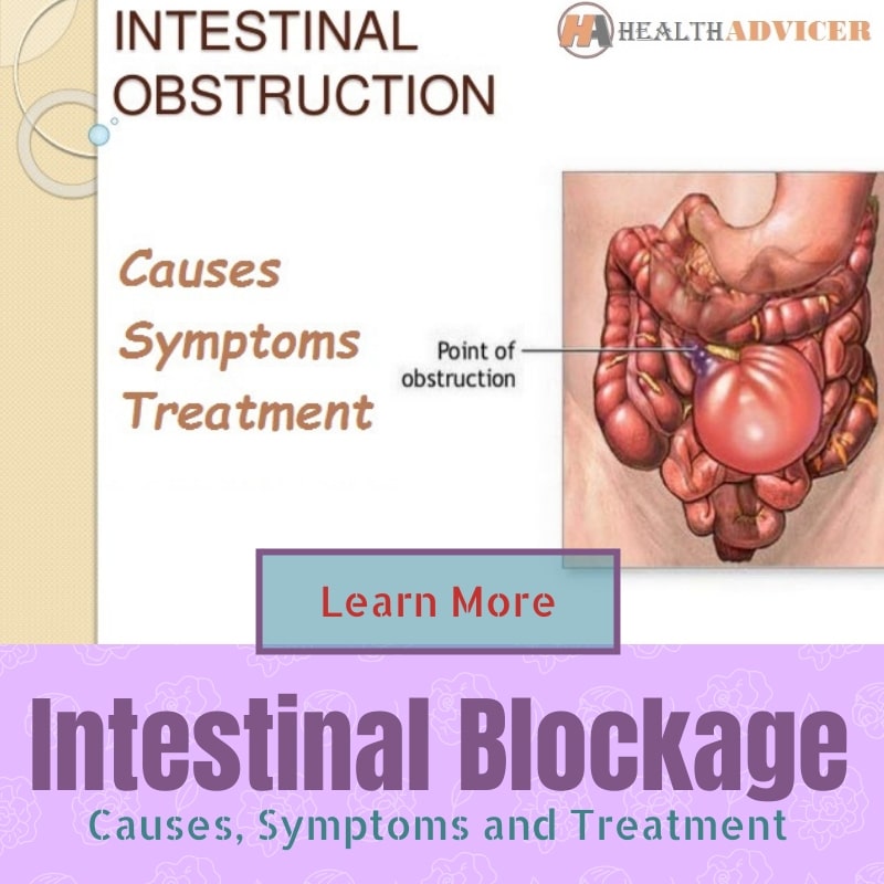 Intestinal Blockage Causes Picture Symptoms And Treatment