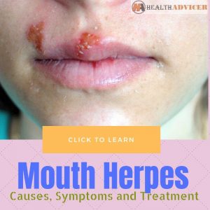 Mouth Herpes - Causes, Picture, Symptoms And Treatment