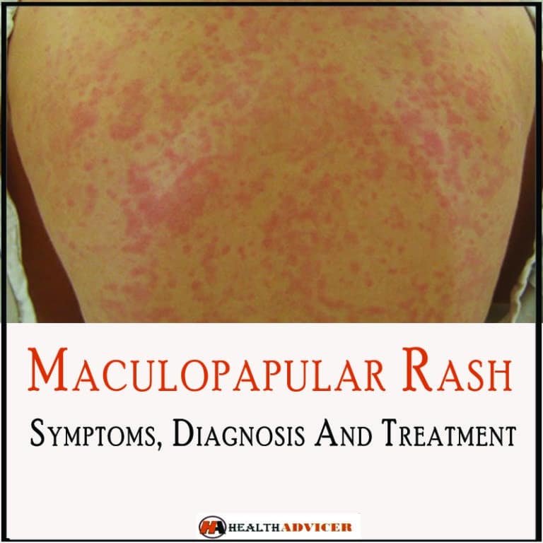 Maculopapular Rash Causes Symptoms And Treatment 5107