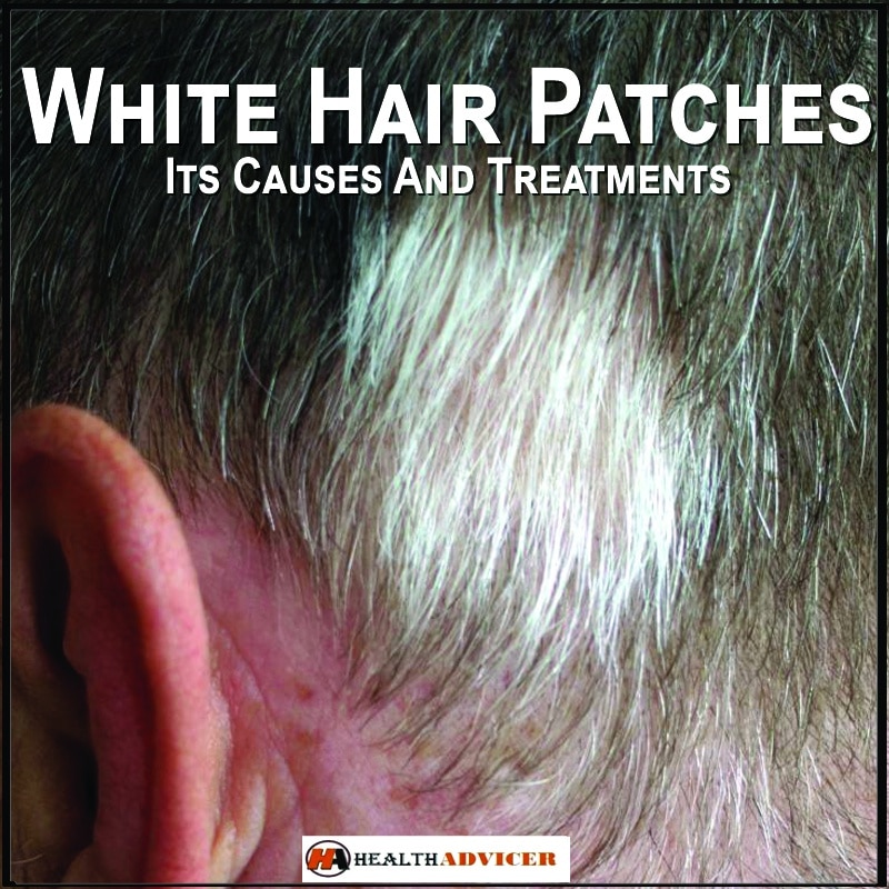 white-hair-patches-its-causes-and-treatments