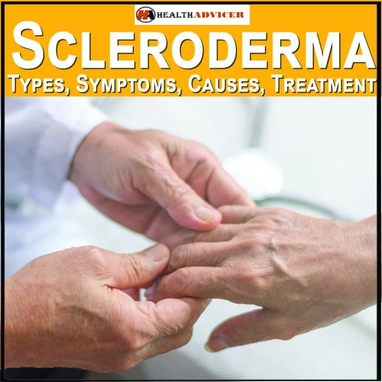 Scleroderma Types Symptoms Causes Treatment